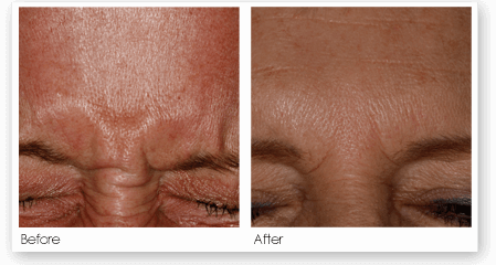 Botox Treatment ottawa